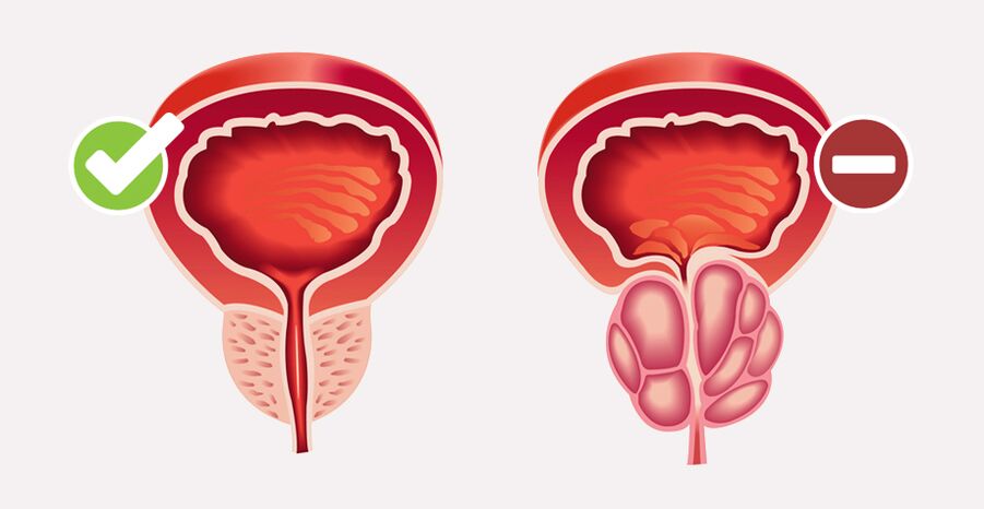 Weiprost normalizes prostate size and function