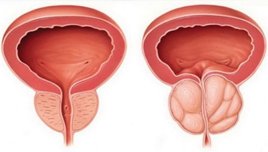 Healthy and inflamed prostate with prostatitis