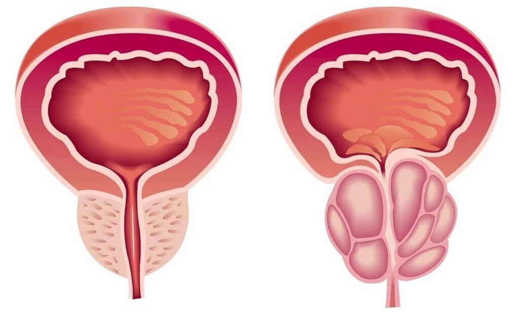 Healthy and Diseased Prostate