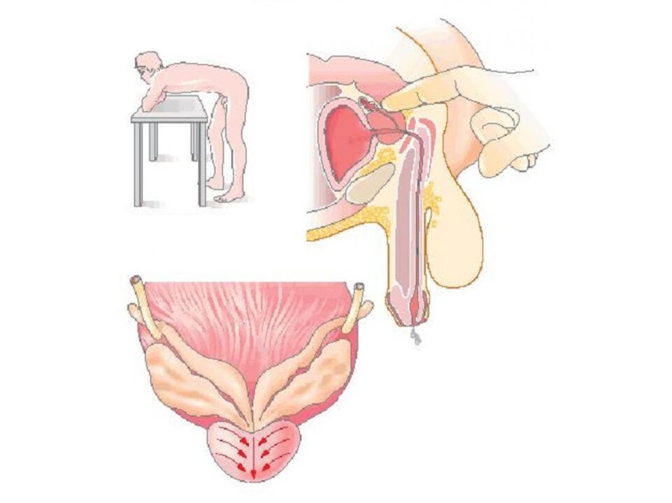 Doctor performs prostate massage technique to analyze secretions